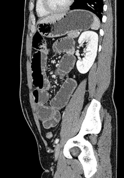 File:Adhesional small bowel obstruction (Radiopaedia 58900-66131 Sagittal C+ portal venous phase 171).jpg