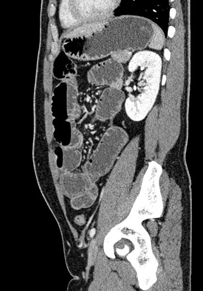 File:Adhesional small bowel obstruction (Radiopaedia 58900-66131 Sagittal C+ portal venous phase 173).jpg