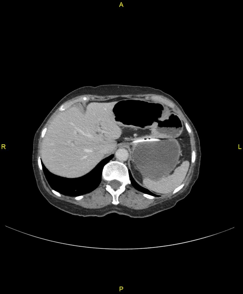 Adhesional small bowel obstruction (Radiopaedia 85402-101024 Axial C+ portal venous phase 56).jpg