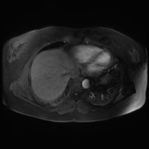 File:Adrenal cortical carcinoma (Radiopaedia 70906-81116 Axial Postcontrast-Dyn T1 fat sat 3).jpg