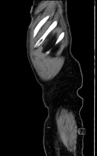 File:Adrenal lymphoma (Radiopaedia 73730-84529 Sagittal C+ portal venous phase 109).jpg