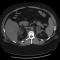 Adrenal myelolipoma (Radiopaedia 8216-9068 Axial non-contrast 20).jpg