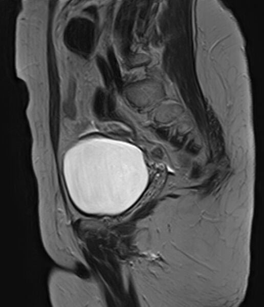 File:Adult granulosa cell tumor of the ovary (Radiopaedia 71581-81950 Sagittal T2 8).jpg