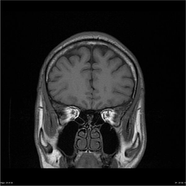 File:Amnestic syndrome secondary to hypoxic brain injury (Radiopaedia 24743-25004 B 20).jpg