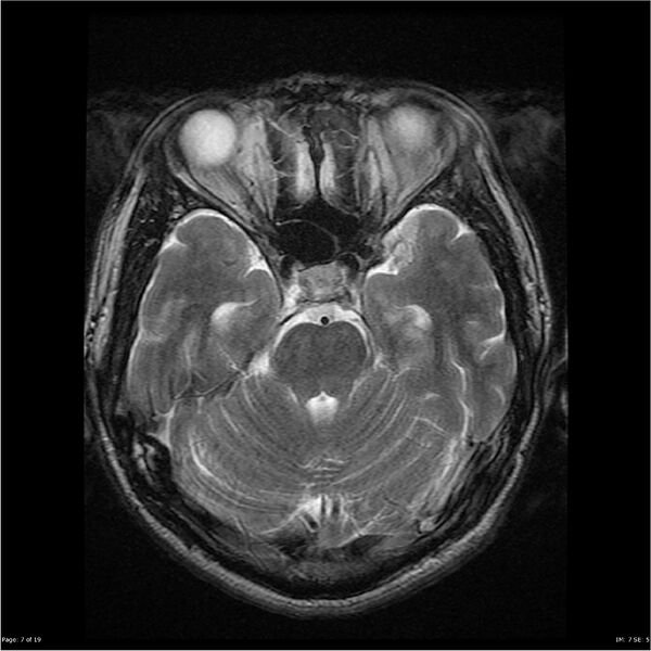 File:Amnestic syndrome secondary to hypoxic brain injury (Radiopaedia 24743-25004 T2 7).jpg