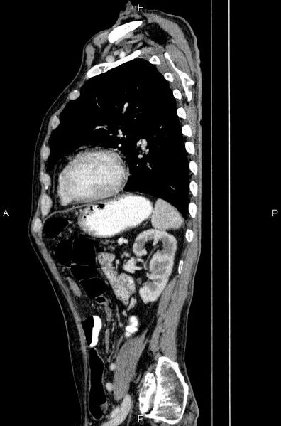 File:Ampullary adenocarcinoma (Radiopaedia 86093-102033 E 66).jpg