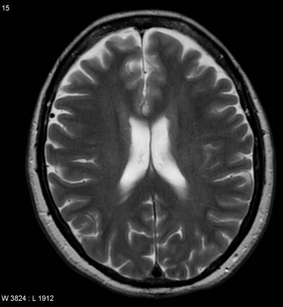 File:Amyotrophic lateral sclerosis (Radiopaedia 5373-7134 Axial T2 15).jpg