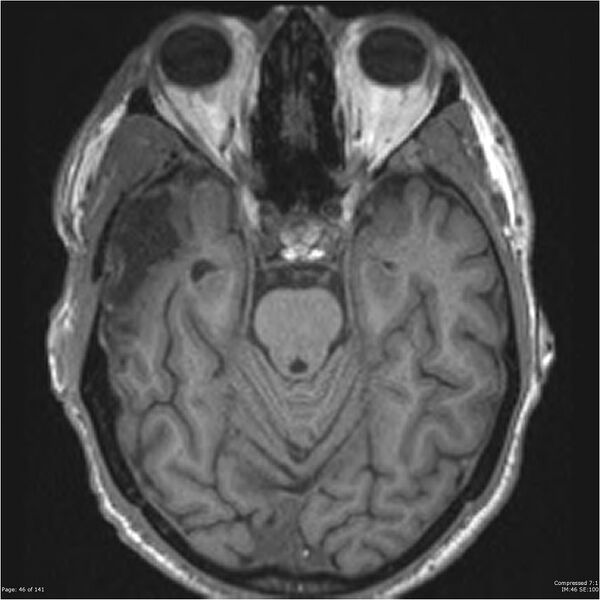 File:Anaplastic meningioma with recurrence (Radiopaedia 34452-35788 Axial T1 44).jpg