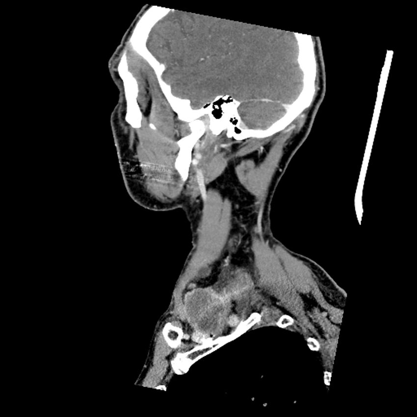 Anaplastic thyroid carcinoma (Radiopaedia 79087-92034 C 22).jpg
