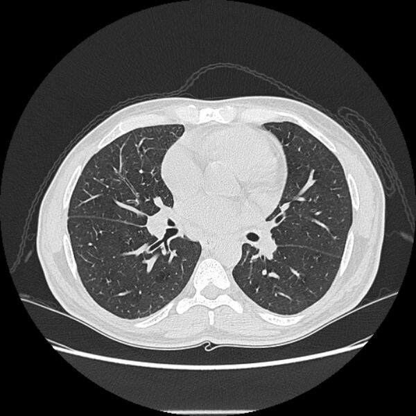 File:Angioinvasive aspergellosis (Radiopaedia 66995-76315 Axial lung window 26).jpg