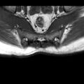 Ankylosing spondylitis with zygapophyseal arthritis (Radiopaedia 38433-40517 B 13).jpg