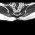 Ankylosing spondylitis with zygapophyseal arthritis (Radiopaedia 38433-40517 B 16).jpg