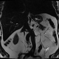 Annular pancreas (Radiopaedia 38292-40320 Coronal T2 11).png
