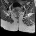 Ano-vaginal fistula (Radiopaedia 29765-30284 Coronal T1 C+ 17).jpg