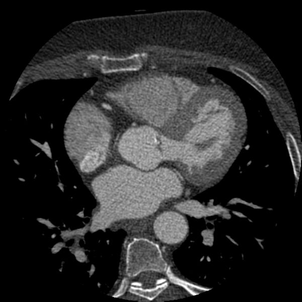 File:Anomalous origin of left circumflex artery from right coronary sinus (Radiopaedia 72563-83117 B 66).jpg