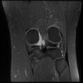 Anterior cruciate ligament tear, Wrisberg rip and bucket-handle tear of medial meniscus (Radiopaedia 75872-87266 Coronal PD fat sat 20).jpg