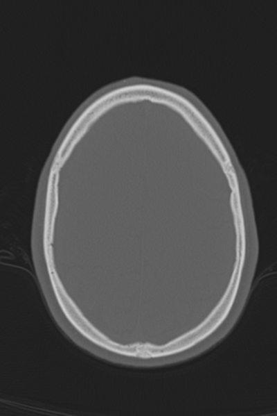 File:Anterior nasal spine fracture (Radiopaedia 46138-50494 Axial bone window 18).png