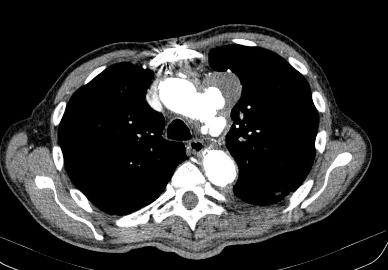 File:Aortic arch saccular aneurysm (Radiopaedia 19430-19457 B 5).jpg