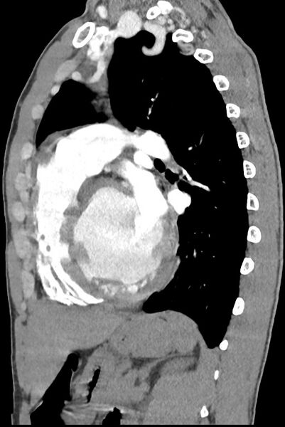 File:Aortic coarctation with aneurysm (Radiopaedia 74818-85828 B 102).jpg