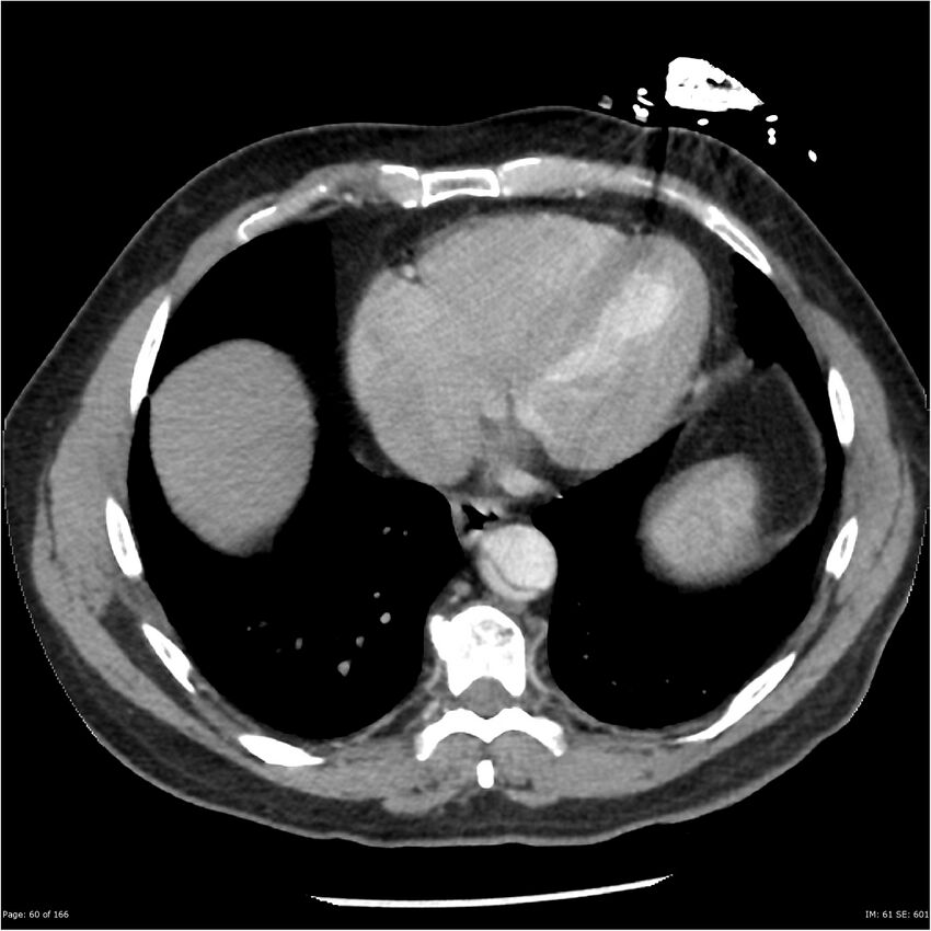 Aortic dissection- Stanford A (Radiopaedia 37759-39664 A 51).jpg