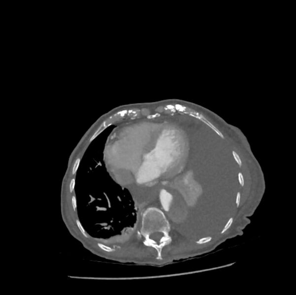 File:Aortic dissection (Radiopaedia 68763-78691 A 40).jpeg