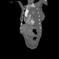 Aortic dissection (Radiopaedia 68763-78691 B 3).jpeg