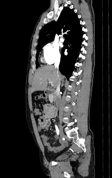 File:Aortic dissection - Stanford type A (Radiopaedia 83418-98500 B 14).jpg