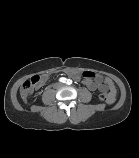File:Aortic dissection with renal ischemia (Radiopaedia 76573-88338 A 85).jpg