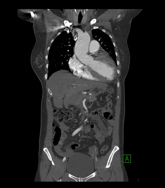 File:Aortic dissection with renal ischemia (Radiopaedia 76573-88338 C 3).jpg