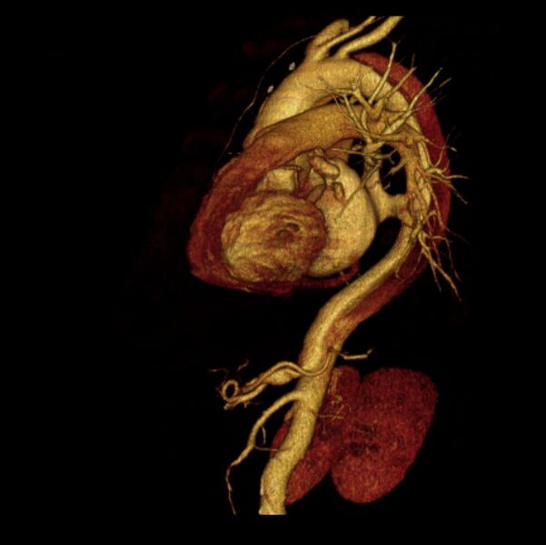 File:Aortic dissection with rupture into pericardium (Radiopaedia 12384-12647 D 30).jpg