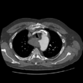 Aorto-coronary bypass graft aneurysms (Radiopaedia 40562-43157 A 29).png