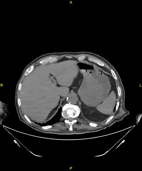 File:Aortoenteric fistula (Radiopaedia 84308-99603 Axial non-contrast 52).jpg