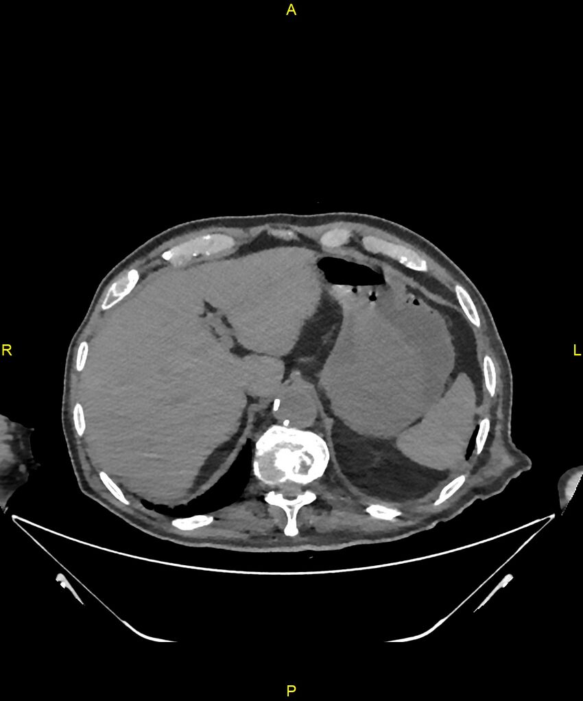 Aortoenteric fistula (Radiopaedia 84308-99603 Axial non-contrast 52).jpg