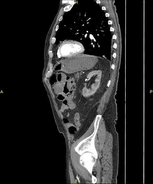 File:Aortoenteric fistula (Radiopaedia 84308-99603 C 251).jpg