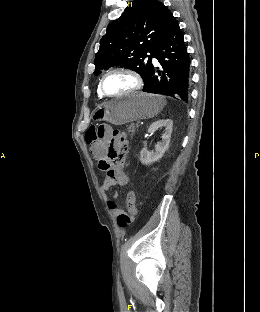Aortoenteric fistula (Radiopaedia 84308-99603 C 251).jpg