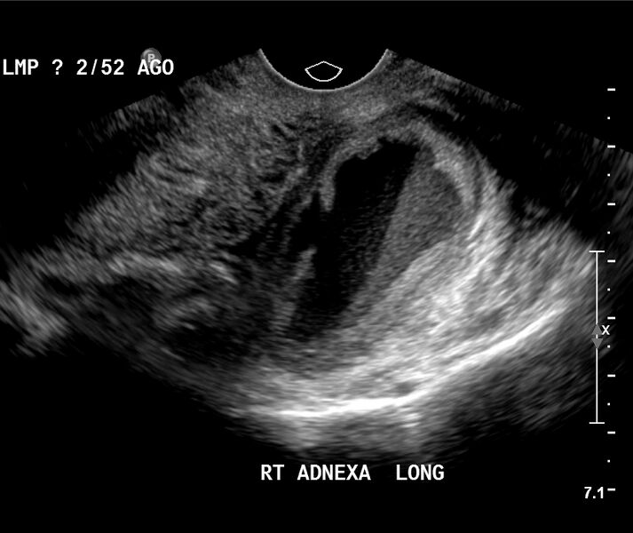 File:Appendiceal abscess (Radiopaedia 13096-13153 A 12).jpg