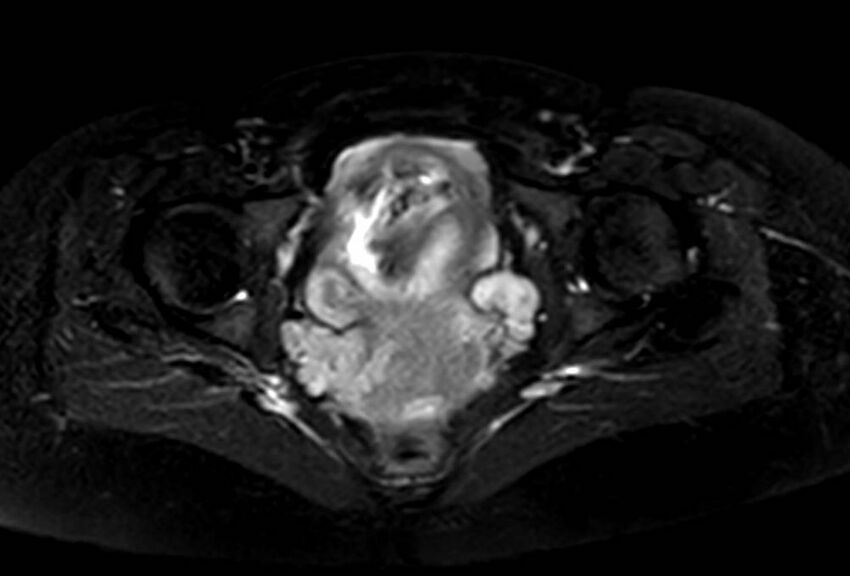 Appendicitis in gravida (MRI) (Radiopaedia 89433-106395 Axial T2 SPAIR 71).jpg