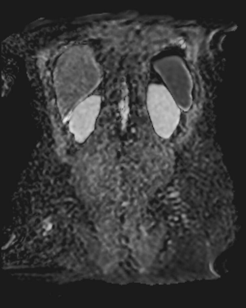 Appendicitis in gravida (MRI) (Radiopaedia 89433-106395 Coronal ADC 47).jpg