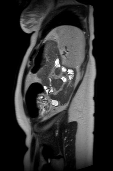 File:Appendicitis in gravida (MRI) (Radiopaedia 89433-106395 Sagittal T2 13).jpg