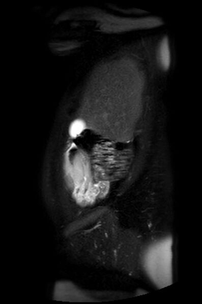 File:Appendicitis in gravida (MRI) (Radiopaedia 89433-106395 Sagittal T2 SPAIR 55).jpg