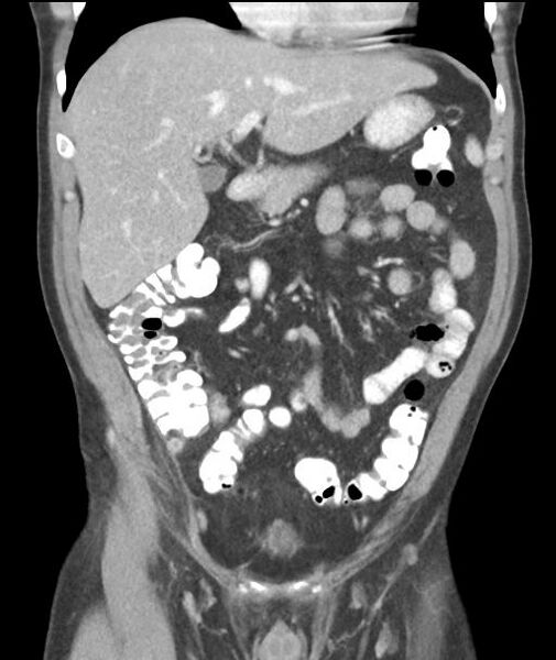 File:Appendicitis with cecal bar sign (Radiopaedia 31878-32830 A 25).jpg