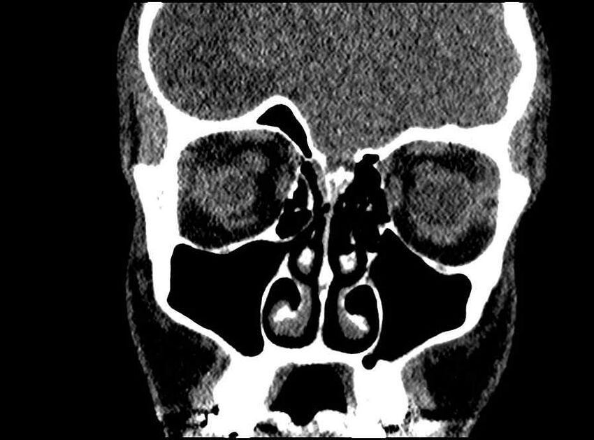 Arachnoid cyst- extremely large (Radiopaedia 68741-78450 Coronal bone window 53).jpg