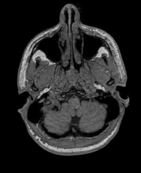 File:Arachnoid cyst- extremely large (Radiopaedia 68741-78451 Axial T1 12).jpg