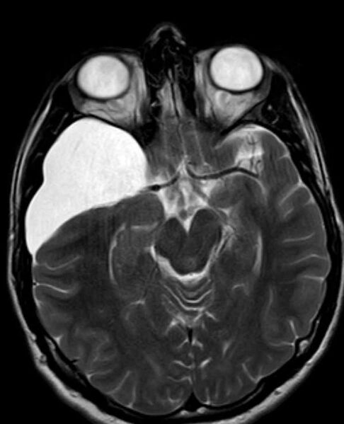 File:Arachnoid cyst- extremely large (Radiopaedia 68741-78451 Axial T2 11).jpg