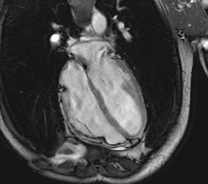 File:Arrhythmogenic right ventricular cardiomyopathy (Radiopaedia 39806-42237 D 66).jpg