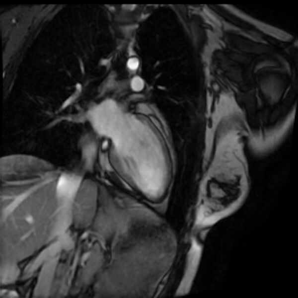 File:Arrhythmogenic right ventricular cardiomyopathy (Radiopaedia 87505-103850 2ch (LV) Cine SSFP 38).jpg