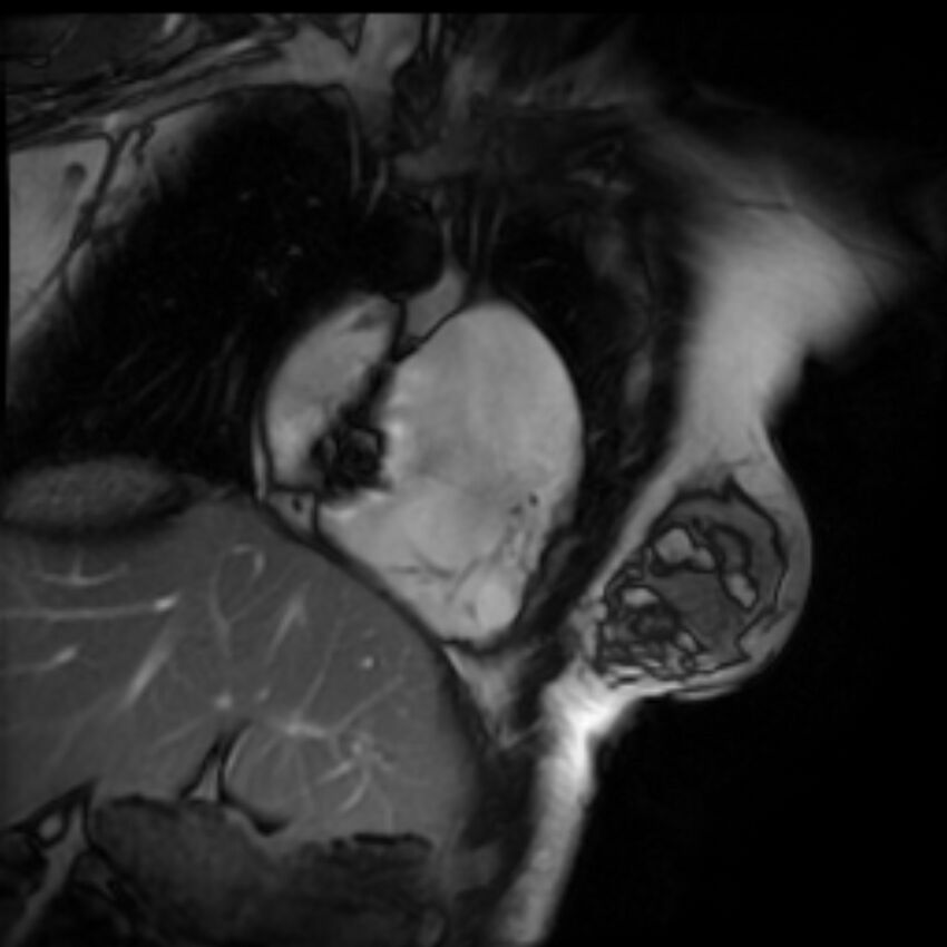 Arrhythmogenic right ventricular cardiomyopathy (Radiopaedia 87505-103850 2ch (RV) Cine SSFP 64).jpg