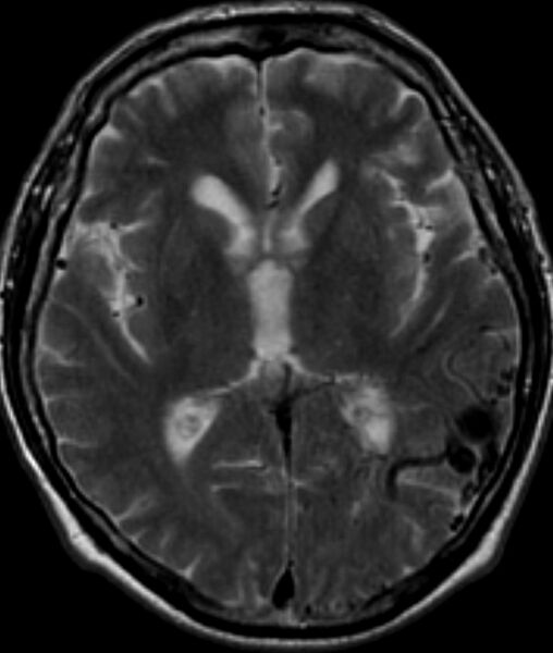 File:Arteriovenous malformation - cerebral (Radiopaedia 15901-15546 Axial T2 1).jpg