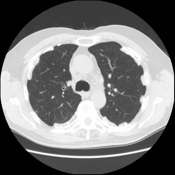 File:Asbestos-related pleural plaques (Radiopaedia 39069-41255 Axial lung window 25).jpg
