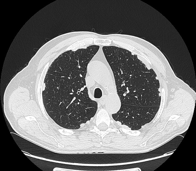 File:Asbestos pleural placques (Radiopaedia 57905-64872 Axial lung window 85).jpg